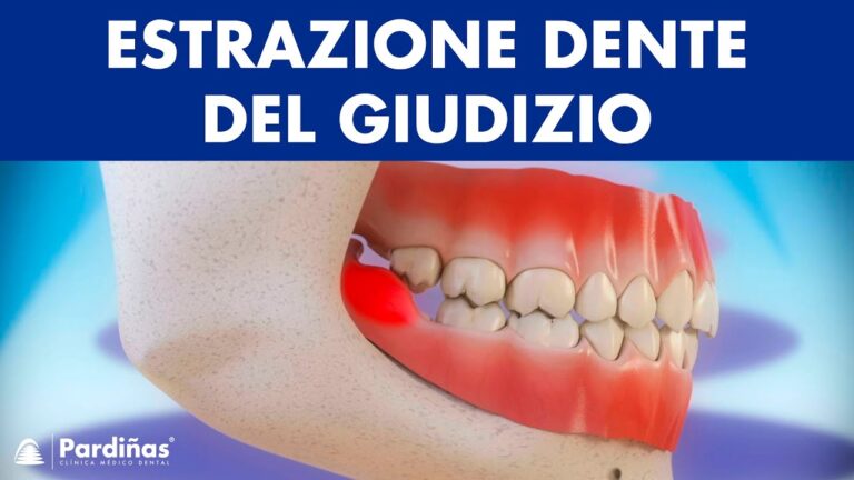 Come trattare la gengiva infiammata causata dal dente del giudizio
