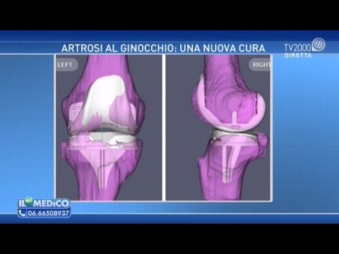 Cruciverba sulla Cartilagine del Ginocchio: Guida Ottimizzata