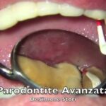 Mascherina per denti notte: guida completa