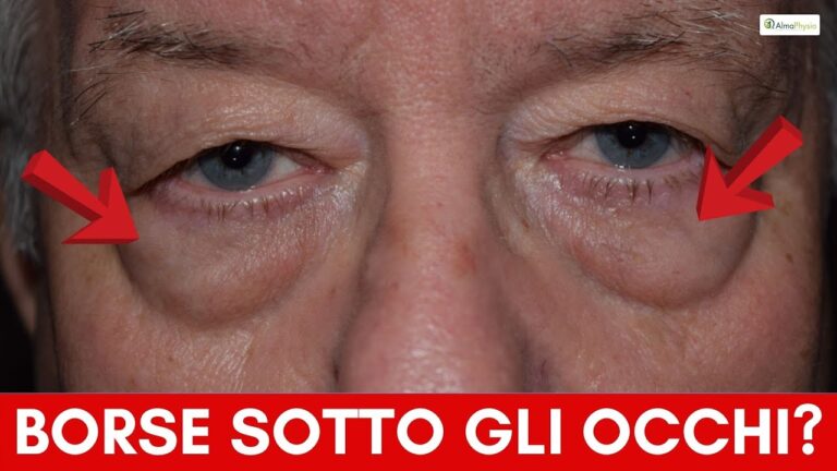 Rimedi Naturali per le Palline di Grasso Sotto gli Occhi