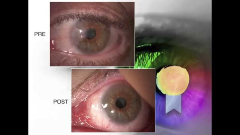 Intervento Laser per Pterigion: Soluzioni Efficaci e Vantaggi
