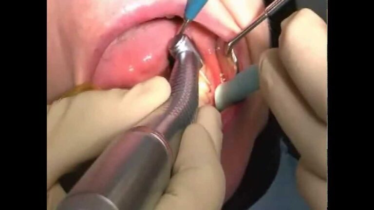 Come trattare un dente marcio sotto capsula