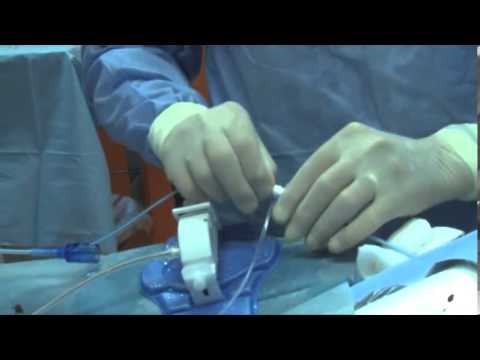 Centri di Eccellenza per Ablazione Cardiaca: Innovazione e Efficacia