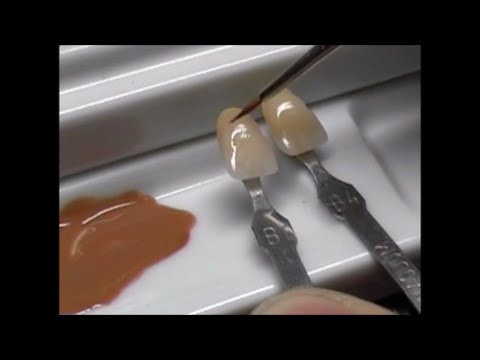 Sbiancamento denti: i segreti dei colori in ceramica per un sorriso impeccabile!