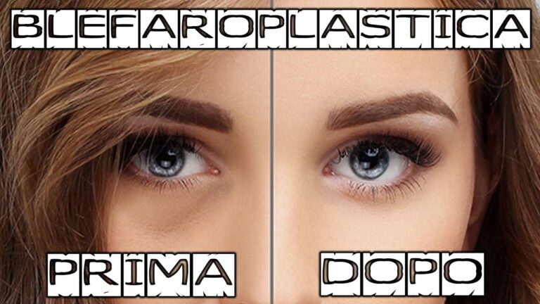 Risultati della Blefaroplastica: Prima e Dopo