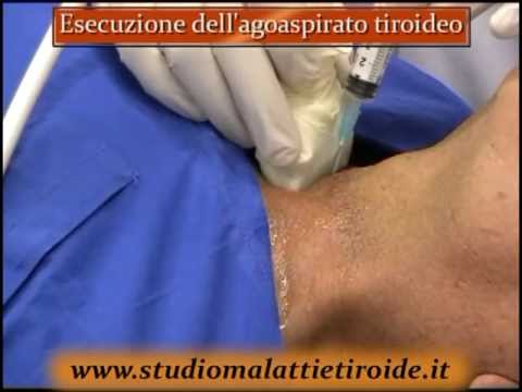 Costo dell’agoaspirato tiroideo: guida completa