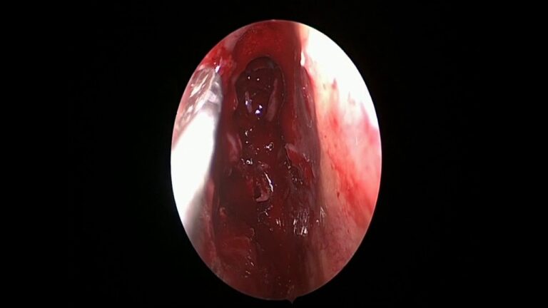 Scopri le inquietanti fotografie del papilloma nel naso: una prospettiva inedita!