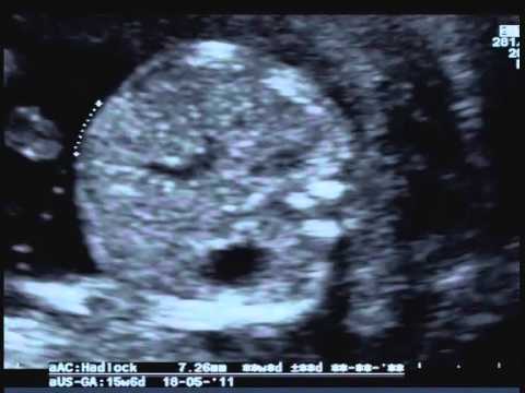 Rivelazioni sorprendenti: Lo sviluppo del maschio feto a 16 settimane