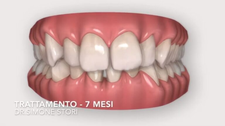 Denti incastrati: il miracolo dell&#8217;affollamento dentale prima e dopo!