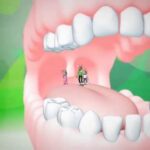 Sindrome di Sjögren e Salute Dentale