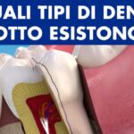 Rischi delle Infiltrazioni nella Colonna Vertebrale