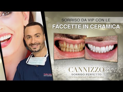Prima e dopo: la trasformazione dei denti con faccette!