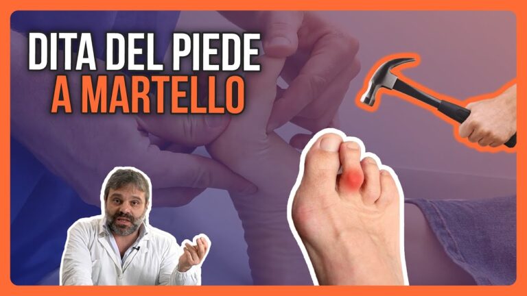 Scarpe Ideali per Alluce Valgo e Dito a Martello