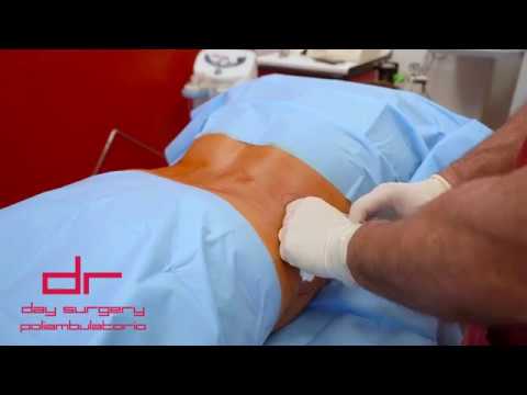 Guida alla Liposuzione della Pancia: Vantaggi e Considerazioni