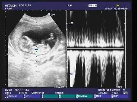 Sorprendente sviluppo del feto maschio a 13 settimane: Scopri le ultime scoperte!