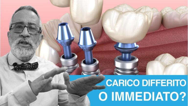 Impianti a carico immediato: i rischi da non sottovalutare