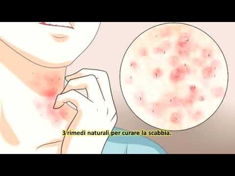 Il bicarbonato di sodio: un rimedio efficace contro la scabbia