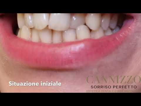 Come assottigliare con i denti: tecniche e consigli efficaci
