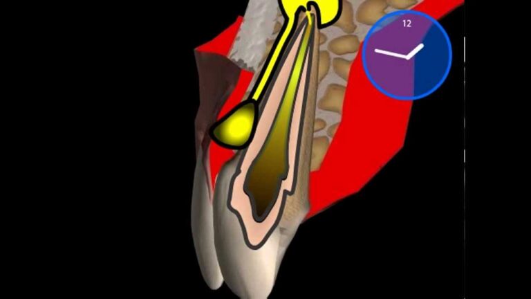 La Fistola Dentale: Diagnosi, Trattamento, e Prevenzione