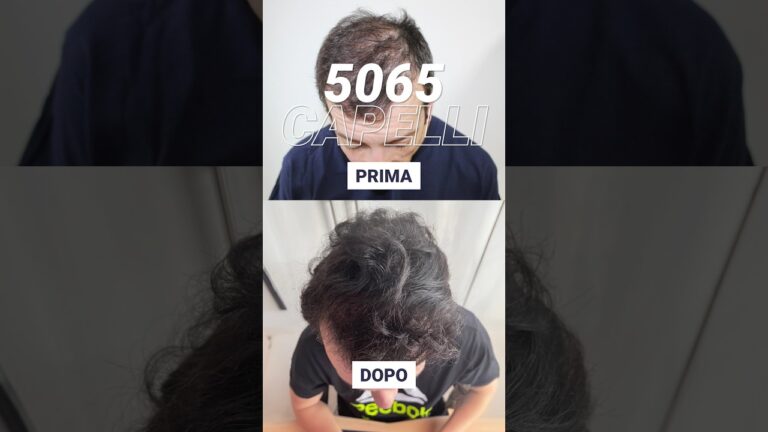 Capelli: Il Fascino del Vertex