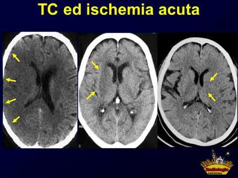 Angio TC Cerebrale: La Diagnosi Ottimizzata per le Patologie Cerebrali