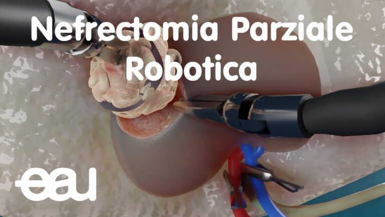 Nefrectomia Parziale: Approccio Efficace per la Neoplasia