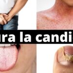 Morfea: Scopri Come Si Guarisce