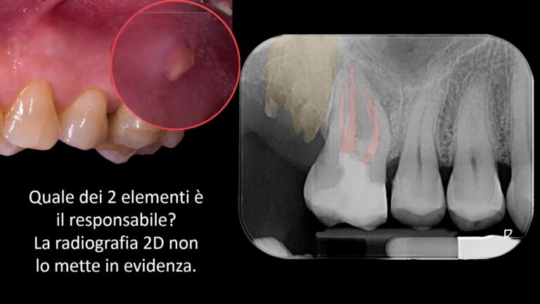 Come trattare un dente devitalizzato doloroso