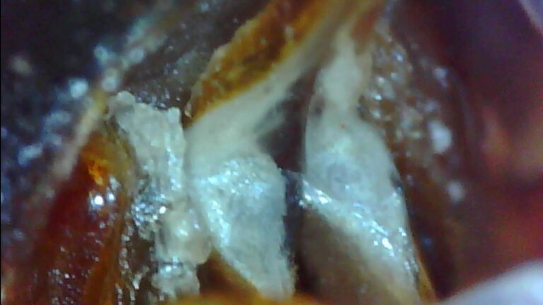 Brufoli sulla vulva: cause, rimedi e prevenzione