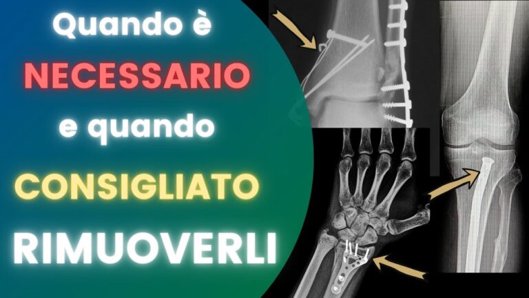 Dolore post-remozione mezzi di sintesi: Strategie di ottimizzazione e gestione