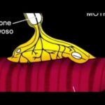 Scoliosi: Rischi e Prevenzione della Malattia