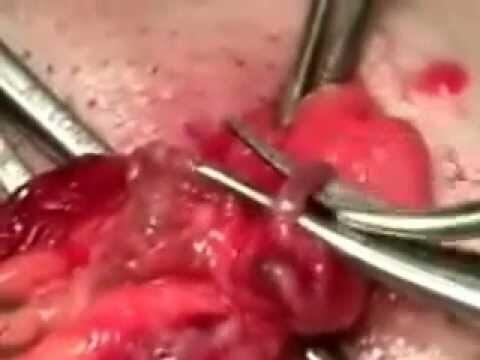 Cicatrice intervento varicocele: come prevenire e curare