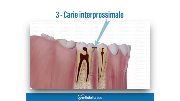 Carie tra i denti: come prevenire e curare