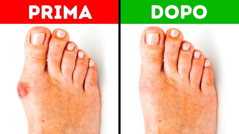 Rimedi naturali efficaci per l’alluce valgo: Segreti delle nonne