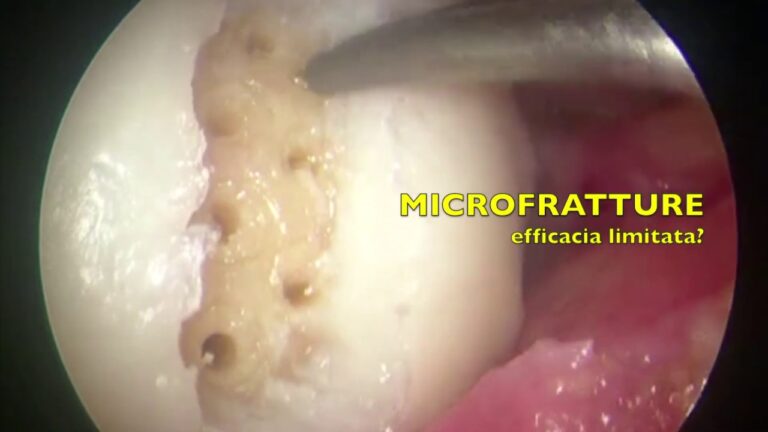 Osteocondrosi del ginocchio: cause, sintomi e trattamento