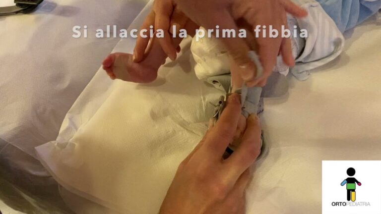Guida pratica per trattare il piede torto: tutorial completo