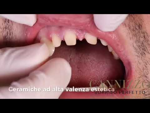 Denti incapsulati: prima e dopo – La trasformazione ottimale del sorriso