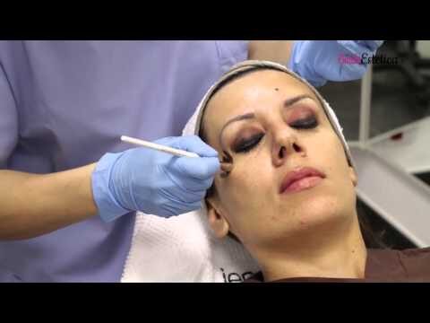 Risultati del Peeling Chimico Viso: Prima e Dopo