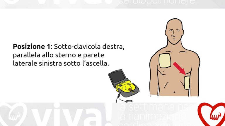Ottimizzazione del Posizionamento delle Piastre del Defibrillatore