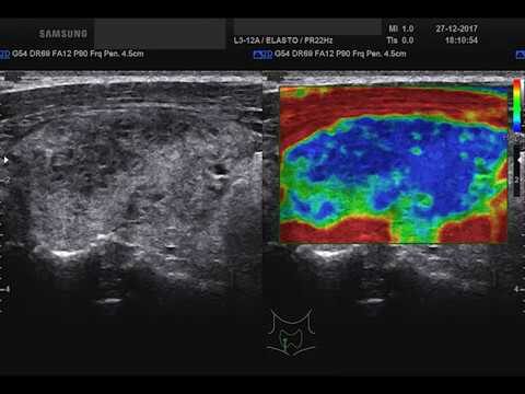 Tiroide di De Quervain: Cause, Sintomi e Trattamenti