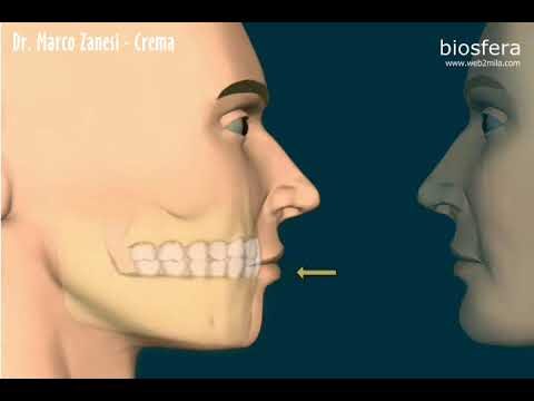 Malocclusione dentale di Classe 2: Cause e Trattamento