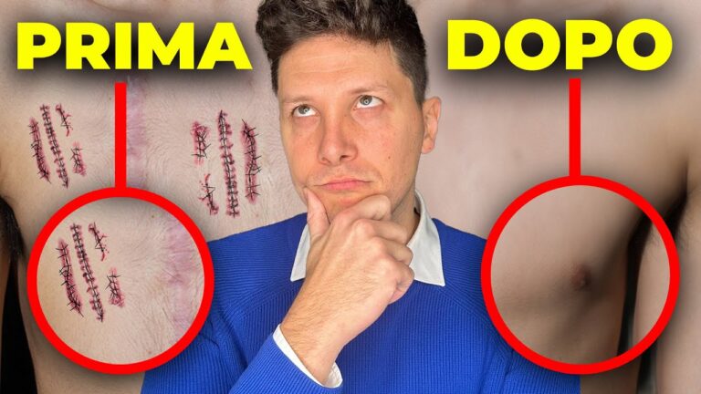 Costi della laserterapia per le smagliature