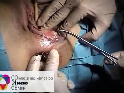 Trattamento efficace per i foruncoli vaginali
