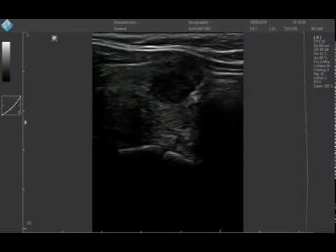 Guida completa al nodulo ipoecogeno: cause, diagnosi e trattamenti