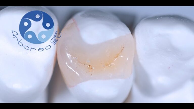 Intarsio dentale: costi ottimizzati
