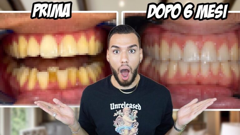 Mascherine per i denti: prima e dopo