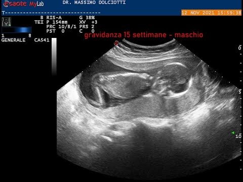 La lunghezza del femore nel feto: importanti considerazioni