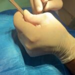 Cisti Corticale: Cause, Sintomi e Trattamenti