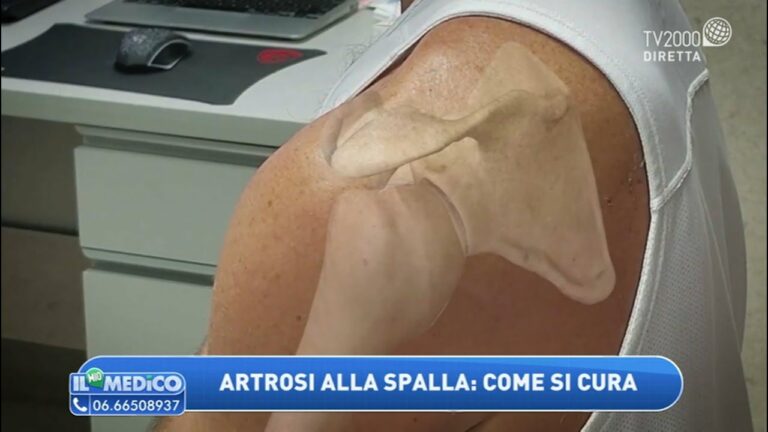 Sintomi dell’artrosi alla spalla: guida completa