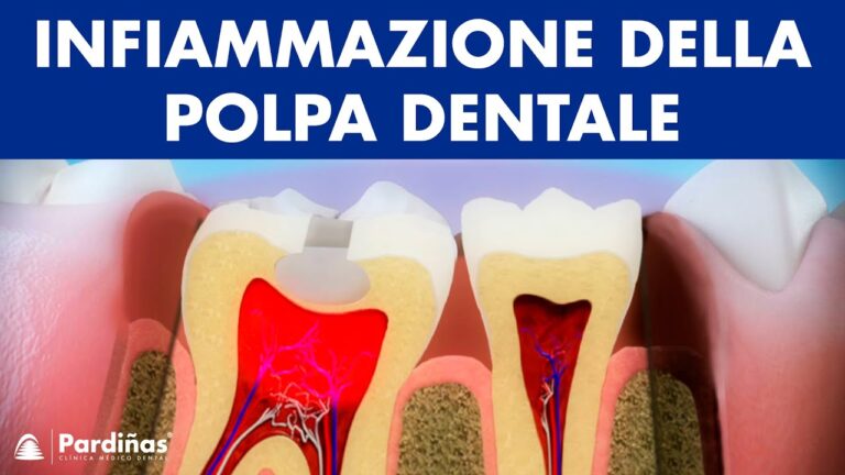 Pulsa il Dente: Cause e Rimedi